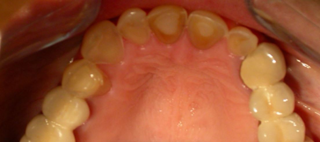 Abrasionsgebiss